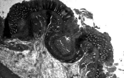 amoebose