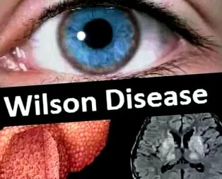 wilson-kór