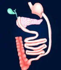 obesity biliopancreaticus