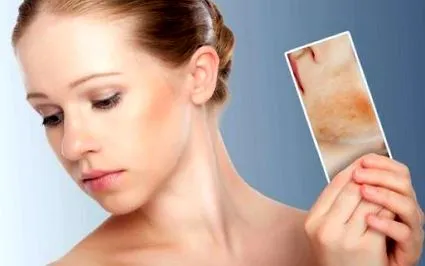 dermatitis
