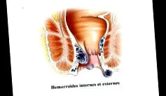 hemorrhoidectomia