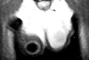 epidermoid