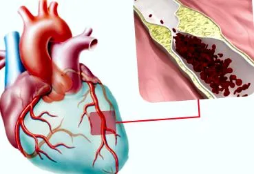 miocardic atacul