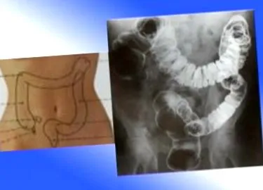 Hidroterapia colonului