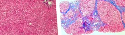 hepatitis szisztémás