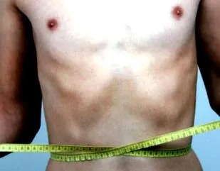 anorexia