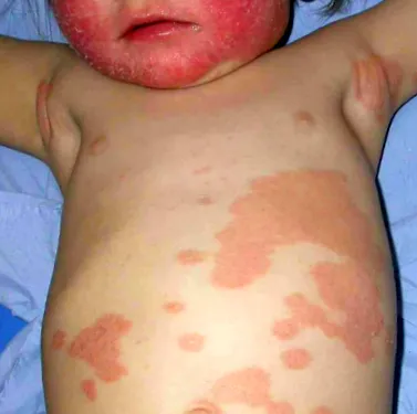 psoriasis