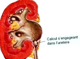 lithiasis