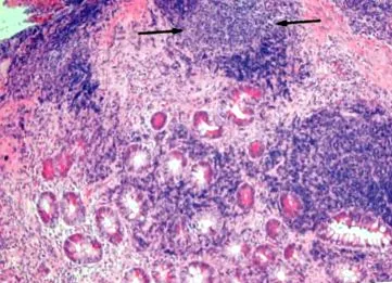 Crohn-betegségben Forrás
