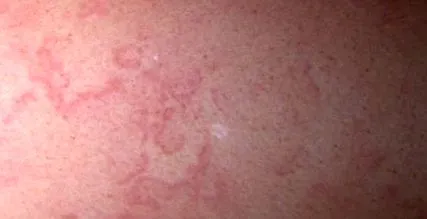 marginális erythema