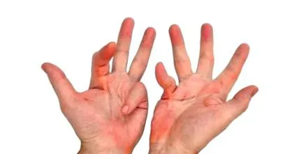 dupuytren dupuytren