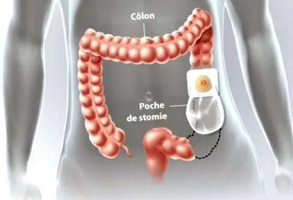 colostomia