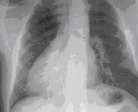 Bronchiectasis Sinusitis