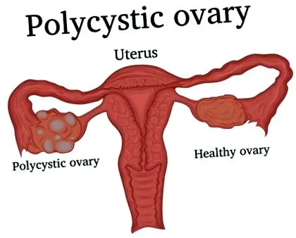 pcos