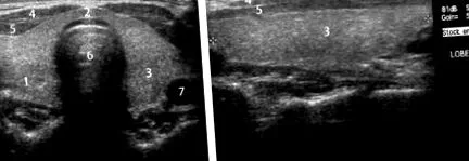 chapter_imagerie_des_endocrine_glandes
