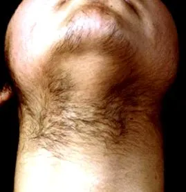 hiperpilozitás cornavin