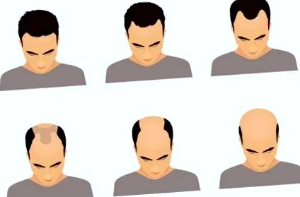 alopecia