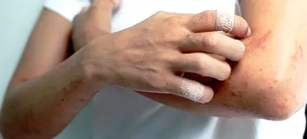 дряпайтеся екзема