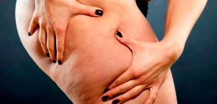 cellulitis