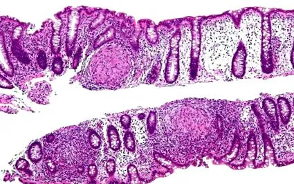 crohn болестта Crohn