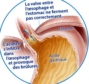 reflux gastrică