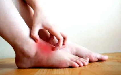 eczemelor