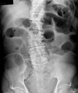 lvulus