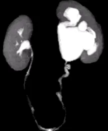 pyelo-ureteralis