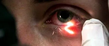 keratitis