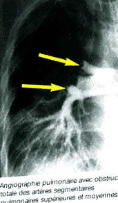 pulmonară pulmonară