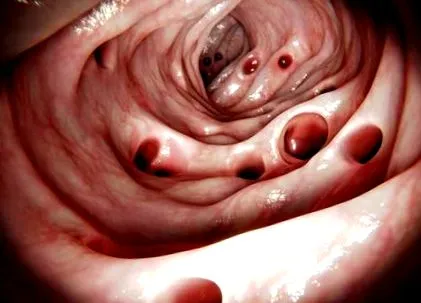 diverticulitis