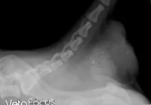 hernia