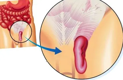 hernia