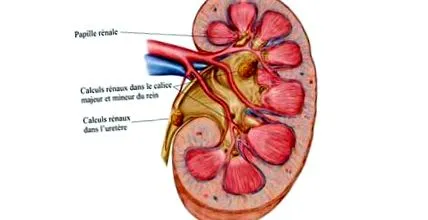 urolithiasis húgyúti