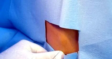 epidurális