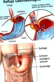 reflux