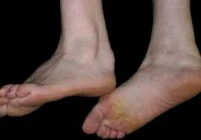xanthomatosis
