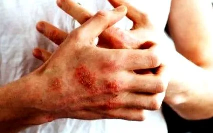 psoriazisului