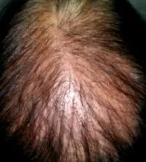 pilaris