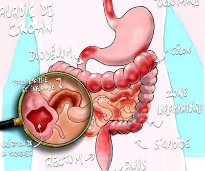 társadalom crohn-kór