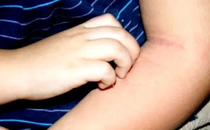 eczema