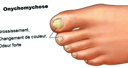 amikor onychomycosis
