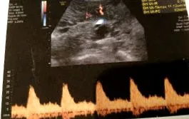 eclampsia