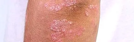 psoriazis psoriazis