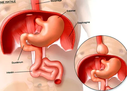 gastroesofagian