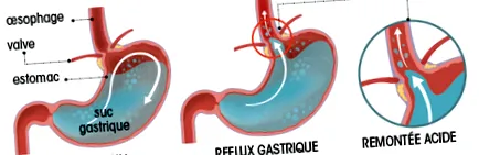 gastroesophagealis