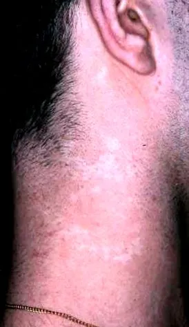 pityriasis