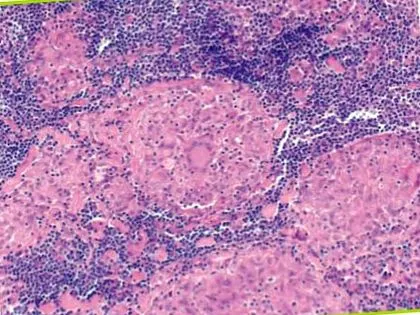 sarcoidosis