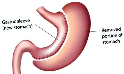 gastrectomie