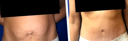 abdominoplasztikával